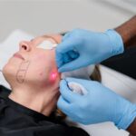 How Does Endolift Work for Facial Contouring