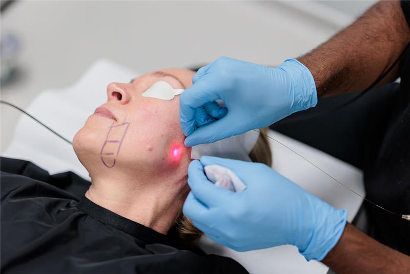 How Does Endolift Work for Facial Contouring