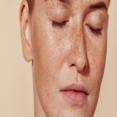 Skin Pigmentation Treatment in Riyadh