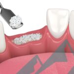 bone grafting in islamabad