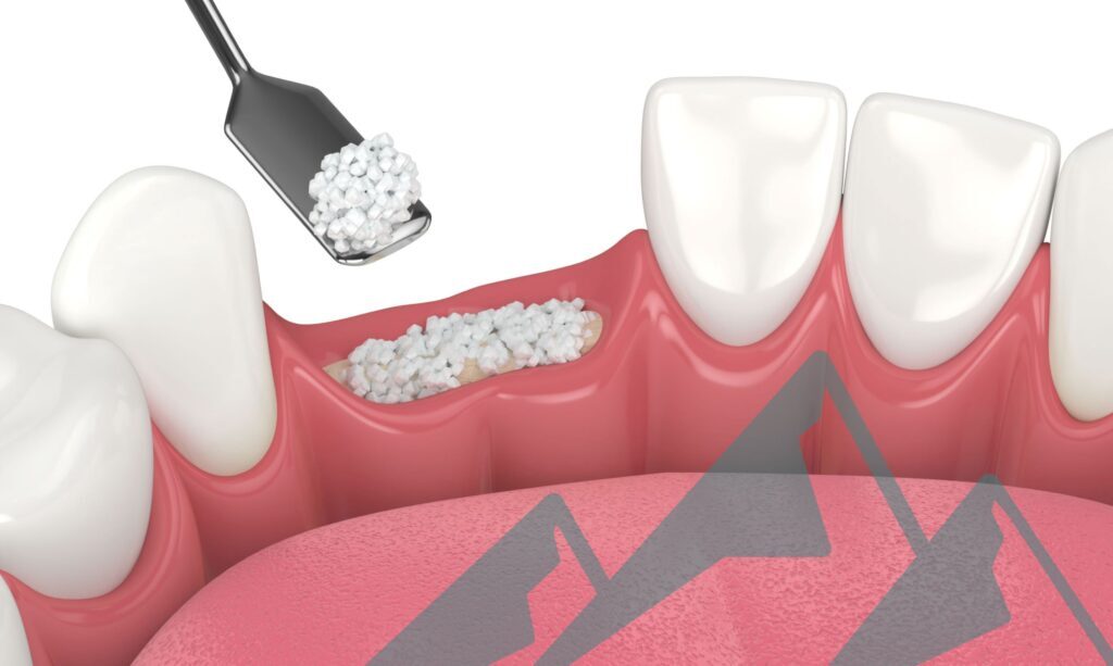 bone grafting in islamabad