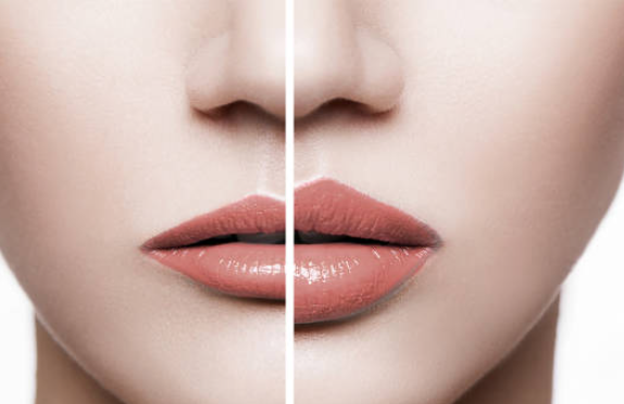 botox before and after lips