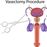 Vasectomy and Neuroimmune Crosstalk in Chronic Post-Procedure Pain