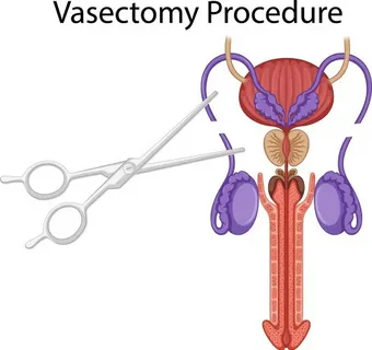 Vasectomy and Neuroimmune Crosstalk in Chronic Post-Procedure Pain