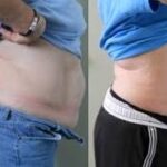 liposuction in islamabad