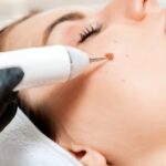 Advanced Wart Removal in Islamabad Clinics