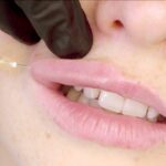 lip augmentation in Islamabad