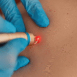 Skin Tags Removal in Dubai