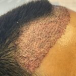 Hair Transplant Cost in Pakistan Based on Number of Grafts