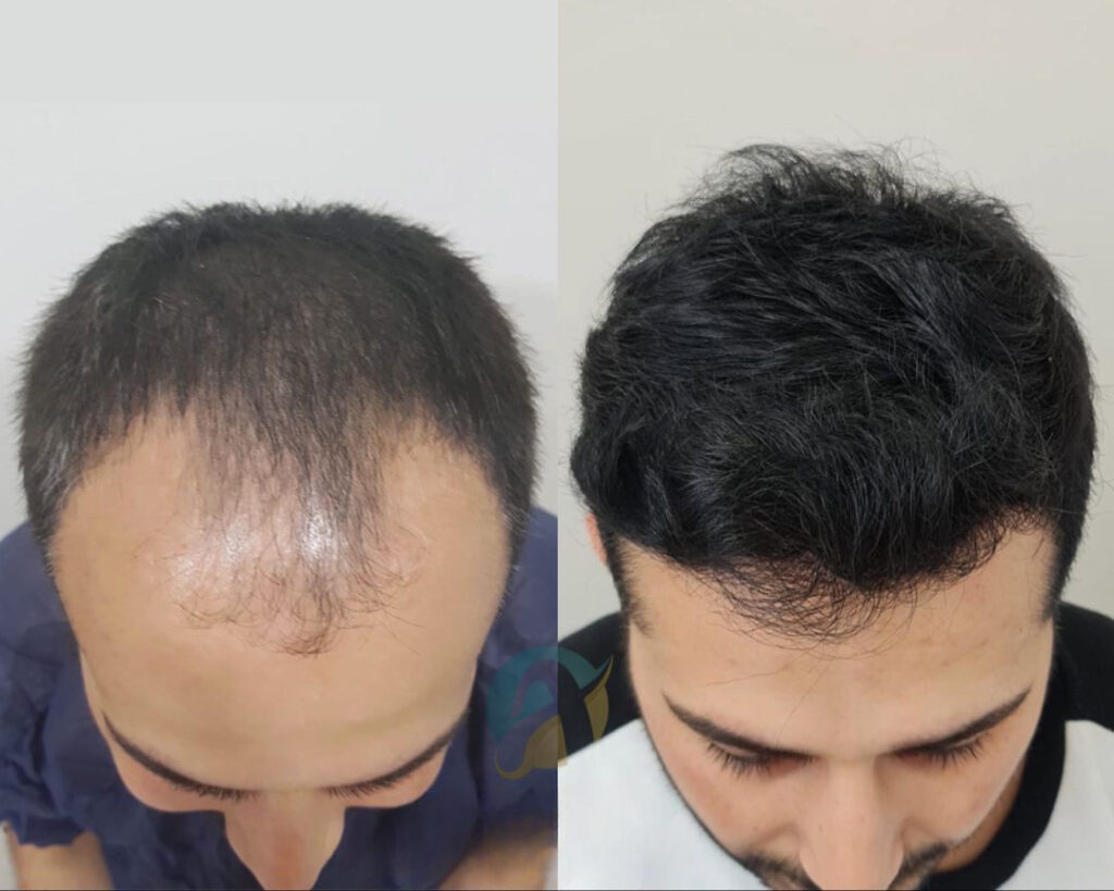 hair transplant i islamabad
