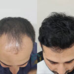 hair transplant i islamabad