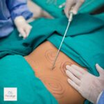 liposuction
